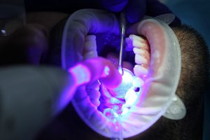 how much does teeth whitening cost. photo by pixbay