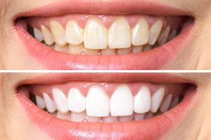 how long does teeth whitening last. photo by pixbay