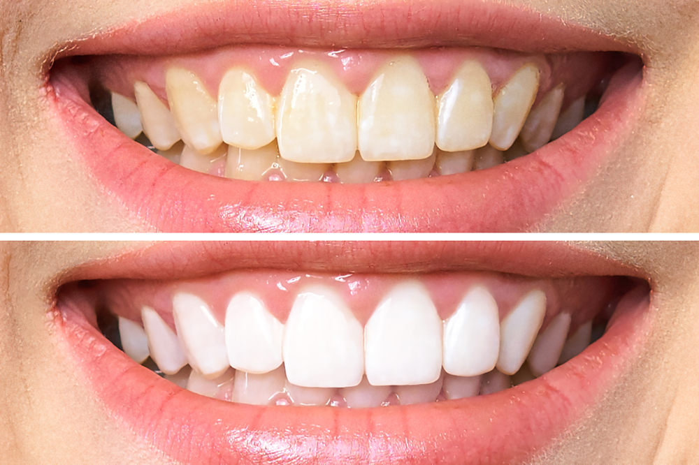 how long does teeth whitening last. photo by pixbay